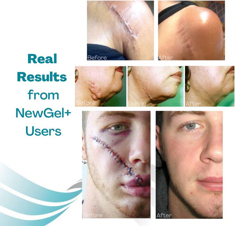 NewGel+ Advanced Silicone Scar Treatment Sheeting - 1mm Thick, Clear, 1 Pair for Areola for Post-Surgery Cosmetic Procedures