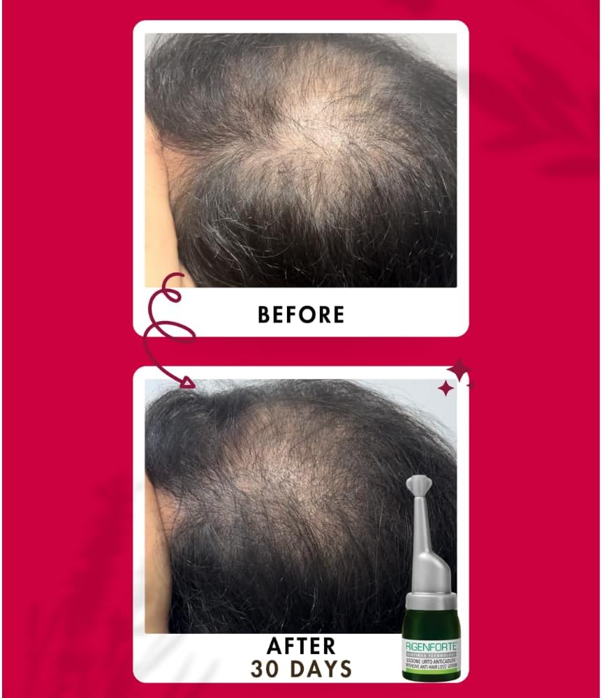 Rigenforte Anti-Hair Loss Lotion 12 Vials with Scalp Massager Brush