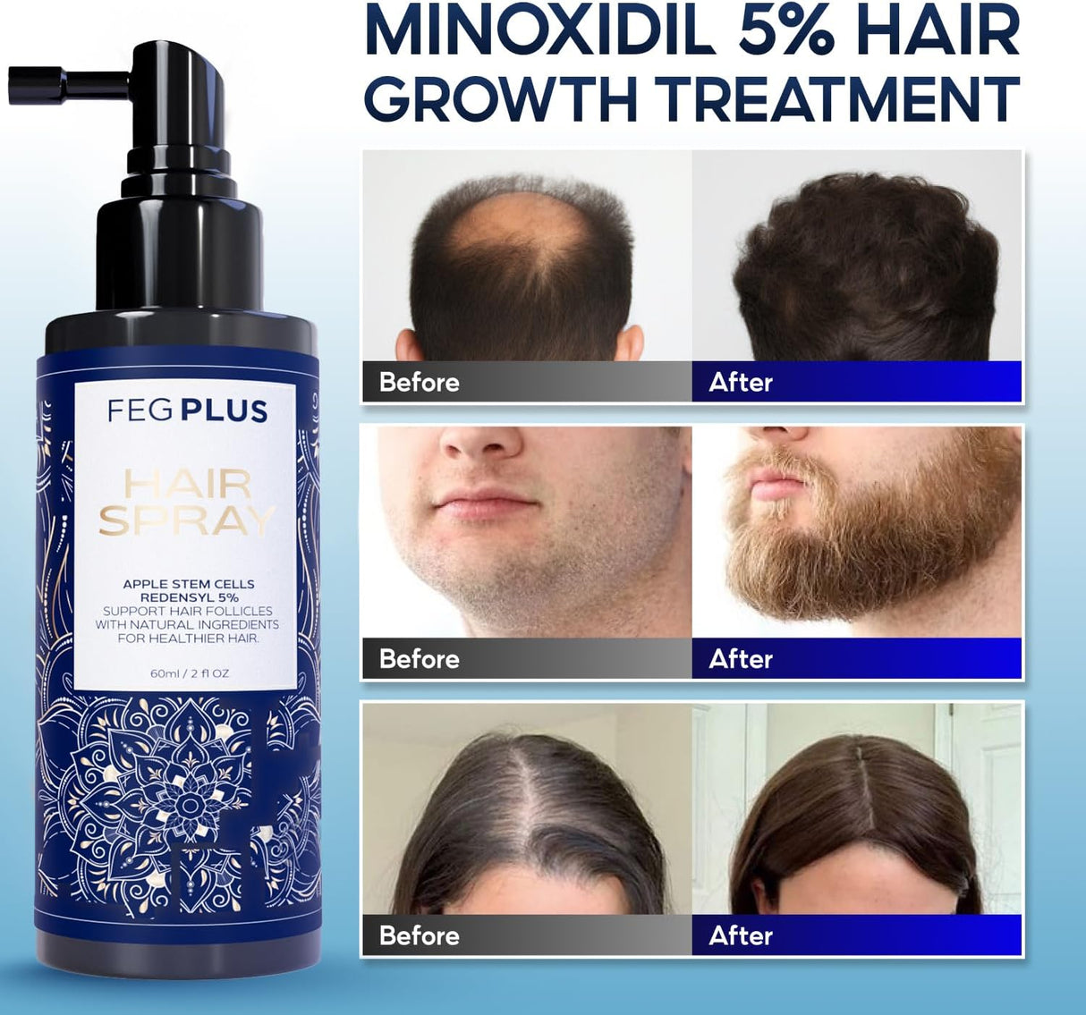 FegPlus Minoxidil Hair Spray & Beard Growth Serum - (60ml)