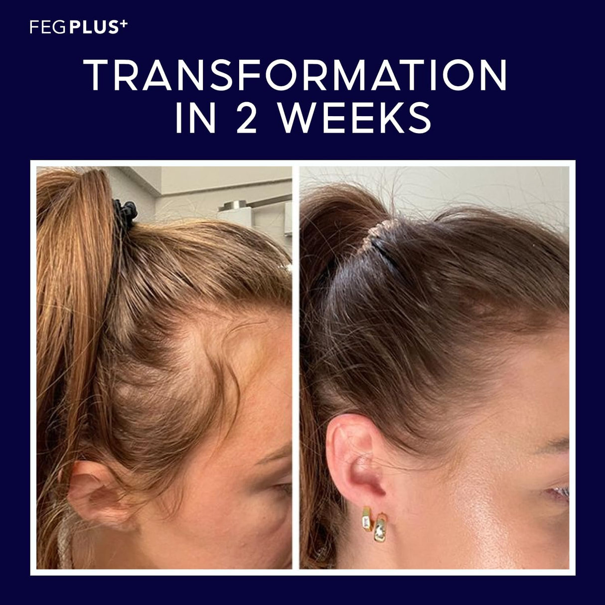 FegPlus Minoxidil Hair Spray & Beard Growth Serum - (60ml)