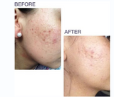 Biodermis Prosil SPF15 Silicone Stick For Scars 4.25g Biodermis