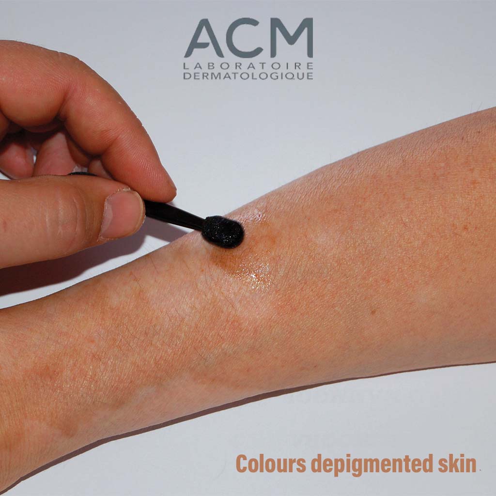 ACM Viticolor Durable Skin Camouflage Gel, Re-Pigmentation Treatment For Vitiligo 50ml